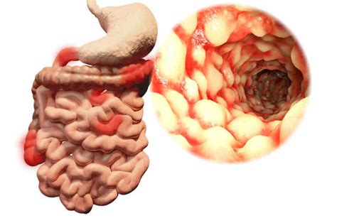 morbo di crohn.